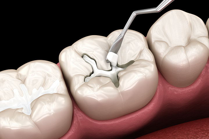 審美歯科イメージ