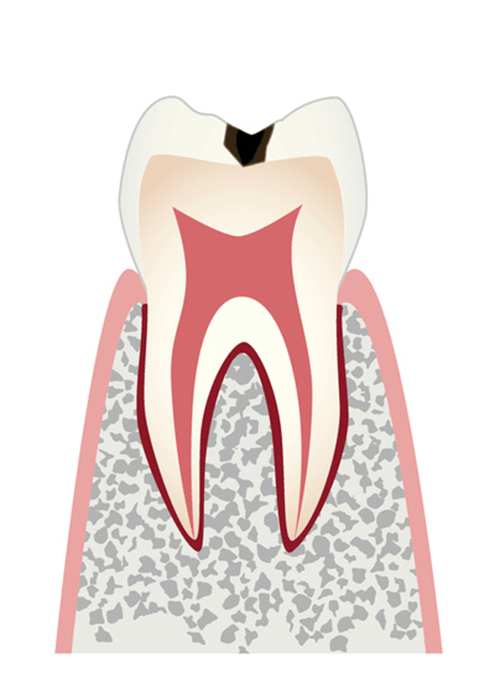 初期の虫歯(C1)