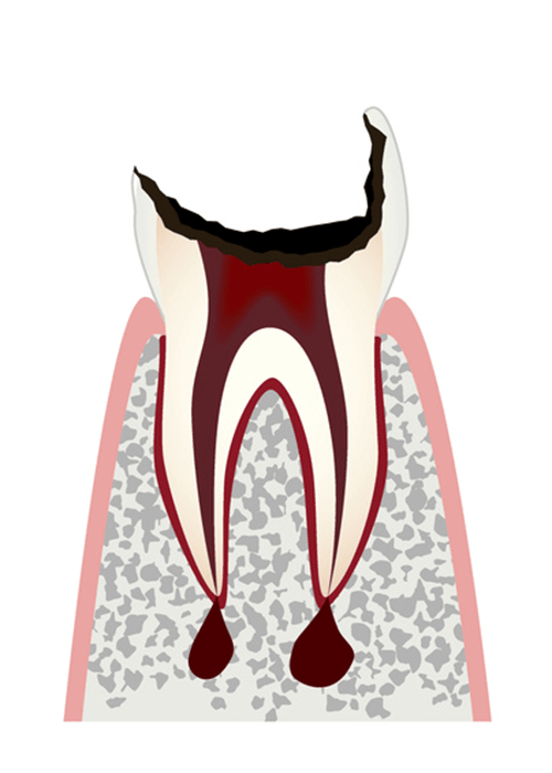 歯の根（歯質）が失われた歯