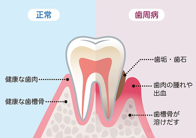 歯周病イメージ