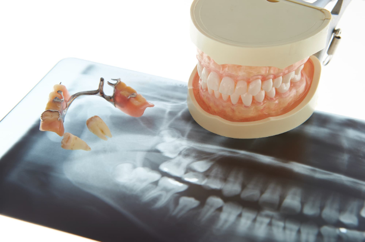 部分入れ歯について解説する歯の模型とレントゲン写真